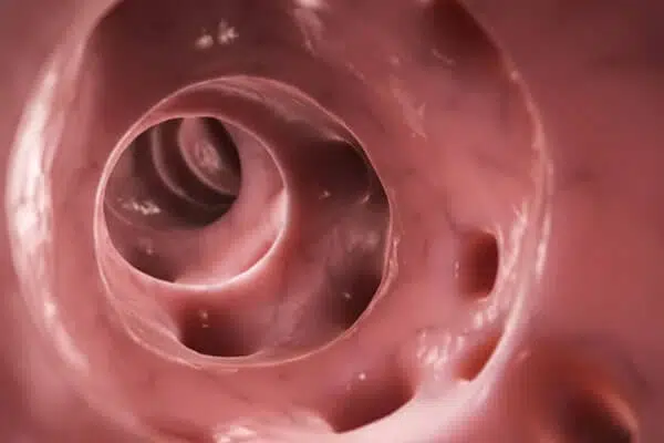 Diverticulosis