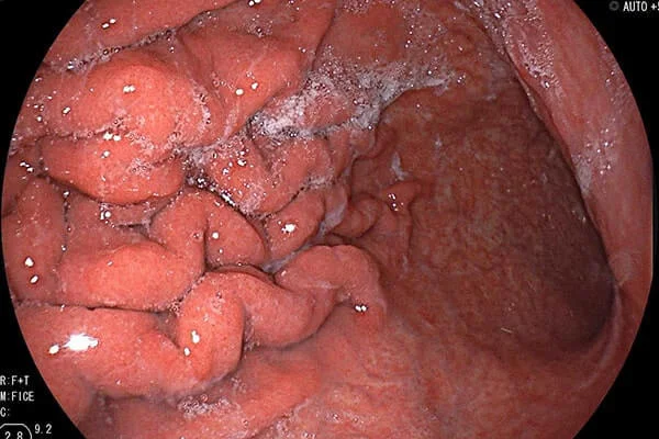 Gastritis